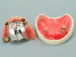 コーヌス・奥歯のアタッチメント入れ歯
